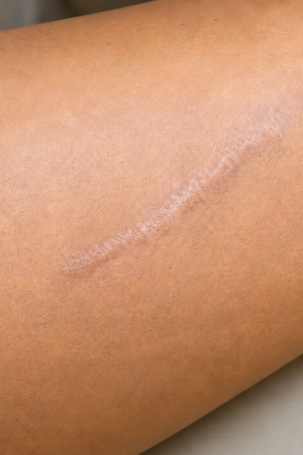 Zichtbaar litteken vóór een behandeling met medische pigmentatie
