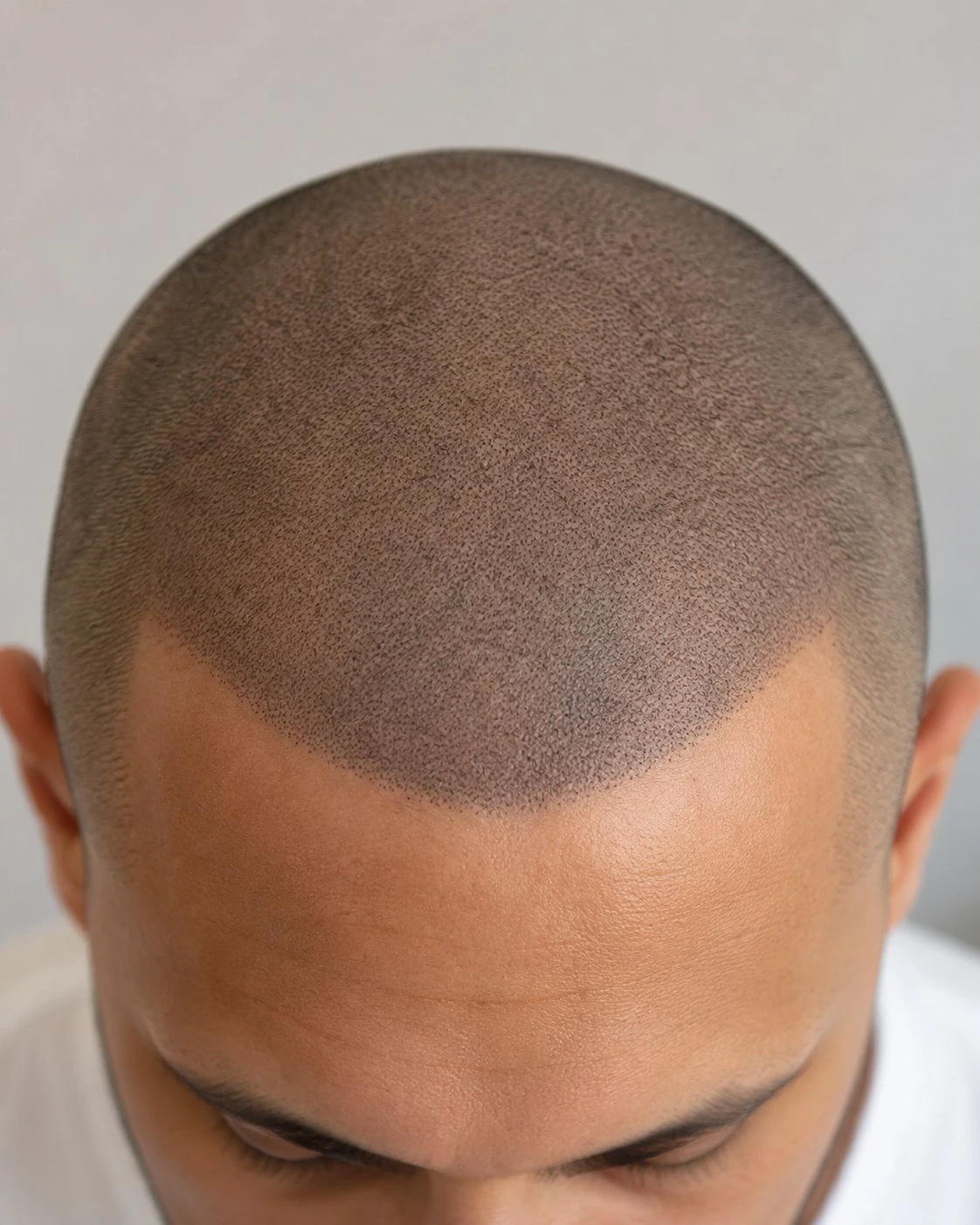 Scalp micropigmentatie bij een man voor een natuurlijke haarlijn en stoppeltjeslook